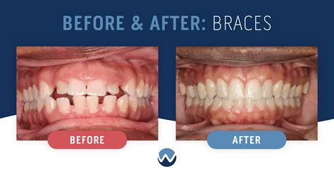 Before And After Braces See The Amazing Results Yourself • Woodhill