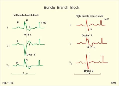 Bundle Branch Block WeCare Germany