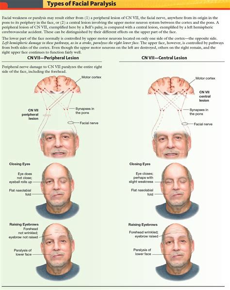 A stroke, on the other hand, is a medical emergency. Types of Facial Paralysis - Peripheral vs Central Lesions ...