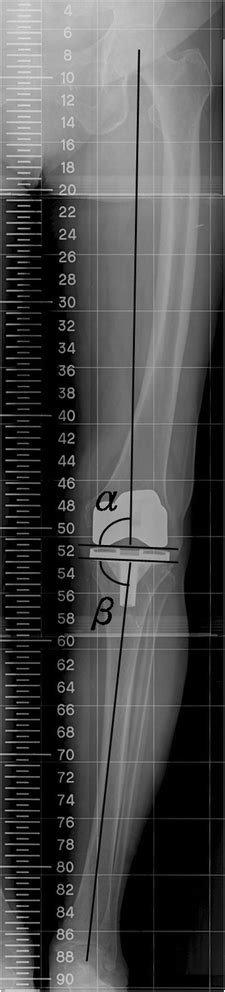 Improved Femoral Component Rotation In Advanced Genu Valgum Deformity My Xxx Hot Girl