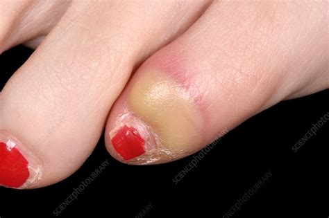 Infected Toe Stock Image C0426312 Science Photo Library