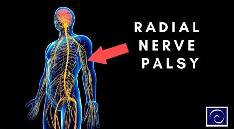 Radial Nerve Palsy ~ Centeno Schultz Clinic