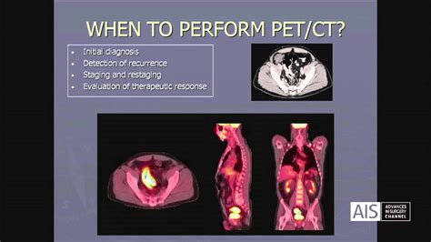 The Use Of PET CT In The Assessment Of Patients With Rectal Cancer