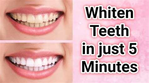 Teeth Whitening Remedy Whiten Teeth Whiten Teeth At Home In 5