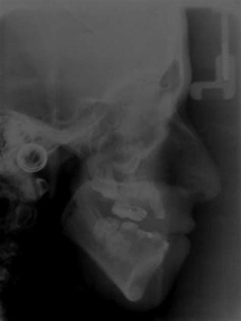 Oral Health Management Of A Patient With 47xyy Syndrome Bmj Case Reports