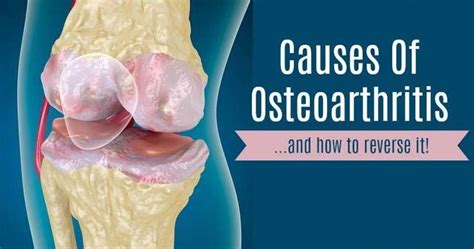 Causes Of Osteoarthritis Osteoarthritis Osteoarthritis What Causes