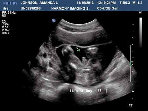 20 Week Ultrasound Girl