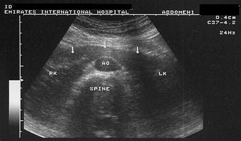 Horseshoe Kidney Found In Ultrasound A Black And White Career