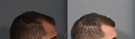 Fue Before After Photos Patient Rochester Buffalo Syracuse