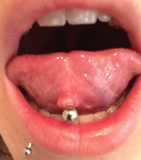 white bump on tongue piercing ph