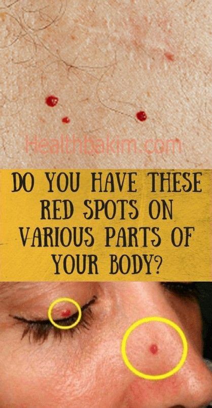 Do You Have These Red Spots On Various Parts Of Your Body Good