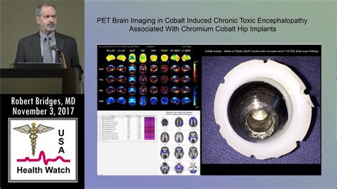 Brain Toxicity From Cobalt In Artificial Hip Implants As Seen On Pet