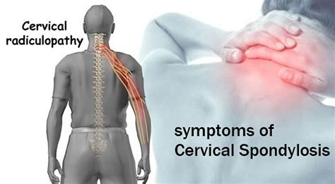 Cervical Spondylosis — Central Illinois Neuro Health Sciences