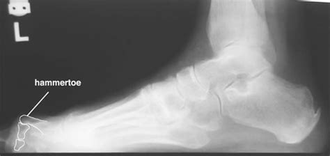 Hammertoe On X Ray Hammertoe Of The 2nd Digit Outline On A Flickr