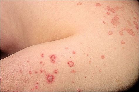 Questions To Ask About Eczema And Atopic Dermatitis Everyday Health