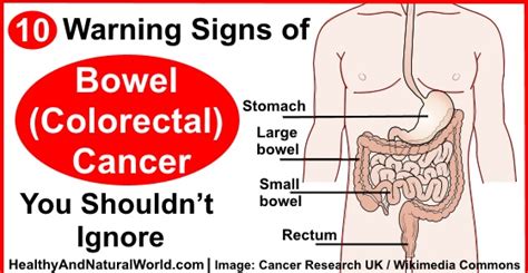 10 Warning Signs Of Bowel Colorectal Cancer You Shouldnt Ignore