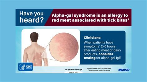 Cdc Sounds The Alarm On Alpha Gal Syndrome American