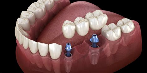 How Is An Implant Attached To The Crown Royal Dental Clinics Blog