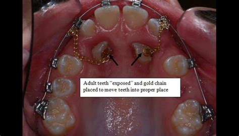 Impacted Tooth Central Orthodontics
