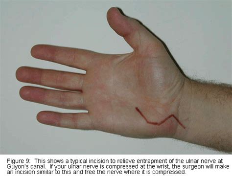 Ulnar Nerve Hand Deformity