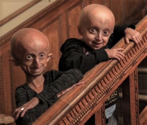 Erken YaŞlanma HastaliĞi Progeria Genetikçe