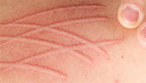 Itching may be accompanied by a rash, flaky and cracked skin, a flaky scalp, spots or bumps on the. Dermatographia: Symptoms, Treatment, and More