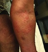 Morbilliform rash involving the left forearm. | Download Scientific Diagram