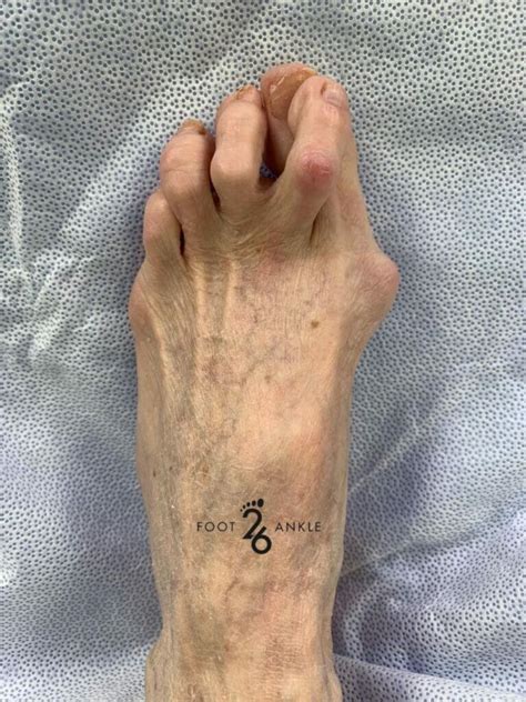 Hammertoe Severe Crossover Toe 26 Foot And Ankle