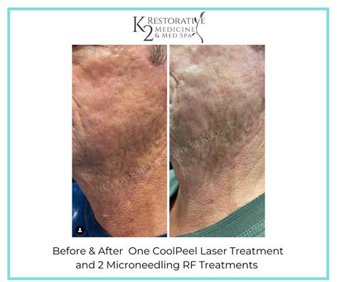 Tetra Co Laser Coolpeel The Latest In Laser Skin Resurfacing