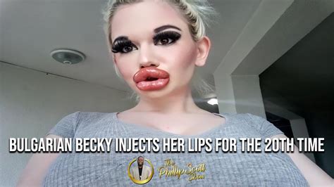 Bulgarian Becky Receives 20th Lip Injection Seeking To Have Biggest Lips In The World Youtube
