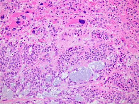 Pathology Outlines Myxoid