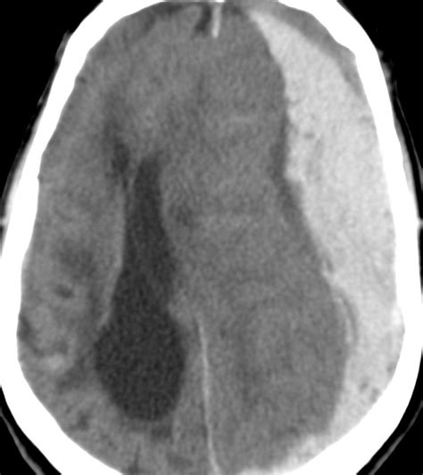 Subdural Hematoma Brain