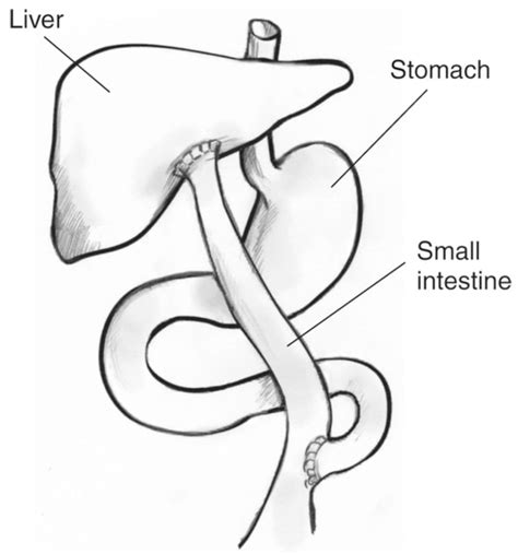 Kasai Procedure Liver Stomach And Small Intestine Labeled Media