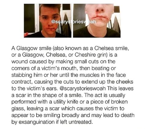 A Glasgow Smile Also Known As Chelsea Smile Or A Glasgow Chelsea Or Cheshire Grin Is A