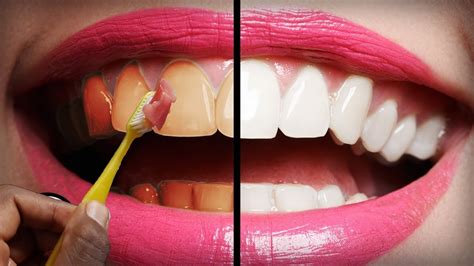 In Just 2 Minutes Turn Yellow Teeth To White Naturally Teeth