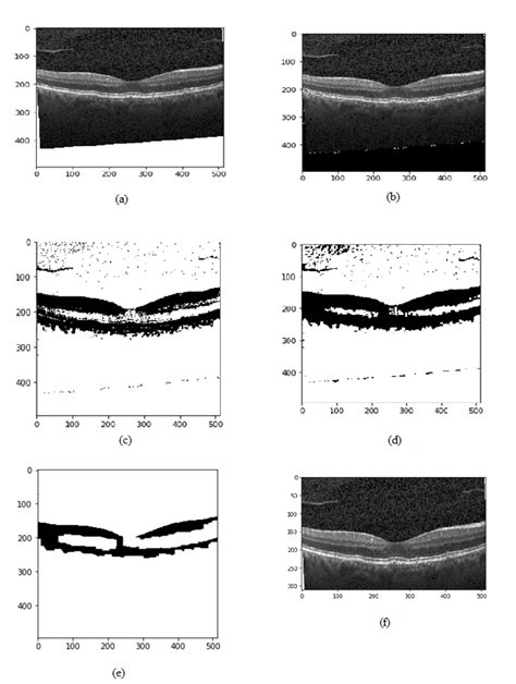 Github Suhailnajeebretinal Oct Classify Classification Of Retinal