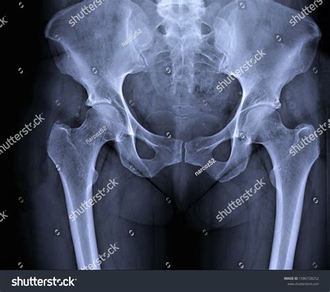 Xray Pelvic Bones Hip Joints Direct Stock Photo 1586728252 Shutterstock