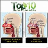 Images of Holistic Remedies For Sinus Congestion