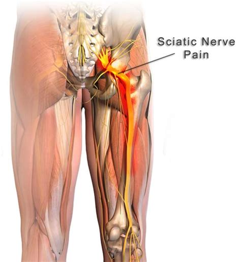 Chiropractic Solutionsnorwoodsciatica And Disc Injuries