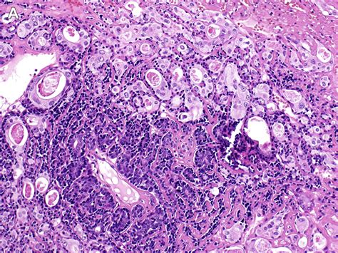 Update On Malignant Sweat Gland Tumors Surgical Pathology Clinics