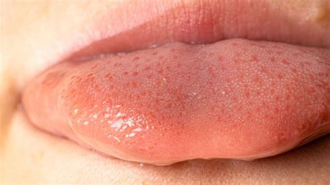 Thrush On Lips Symptoms And Treatment Of Lip Fungus