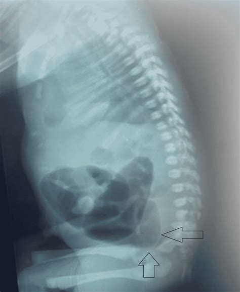 Cureus Type Ileal Atresia And Anorectal Malformation In A Neonate