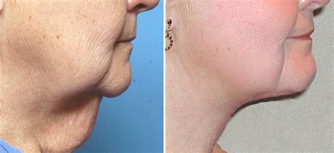 Female Direct Necklift One Week Result Side View Ddr Barry Eppley