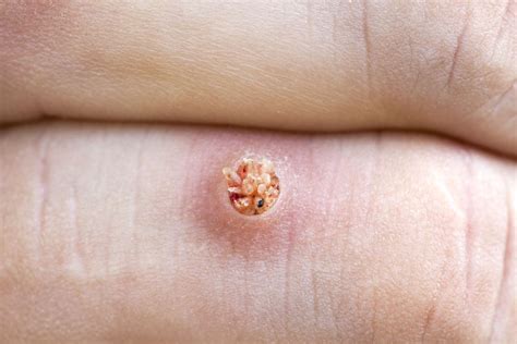 Plantar Wart Root Depth Bruin Blog