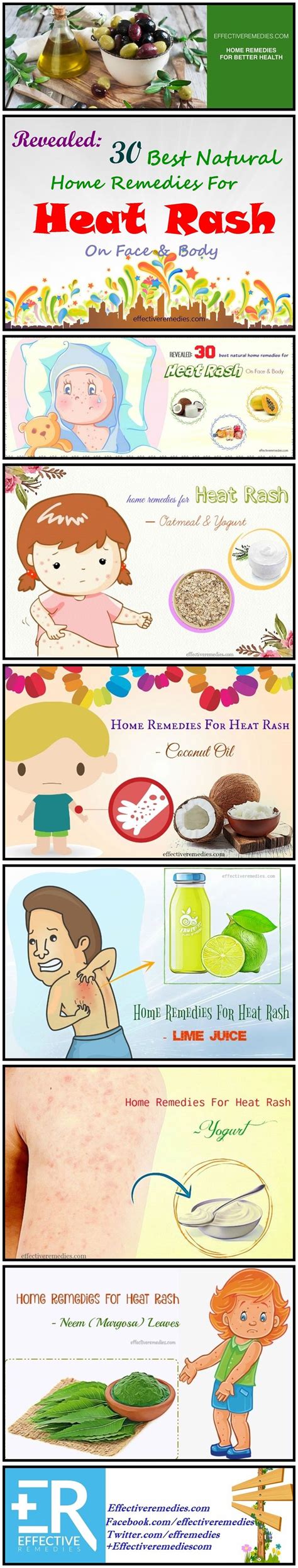 Revealed 30 Best Home Remedies For Heat Rash On Face And Body Heat