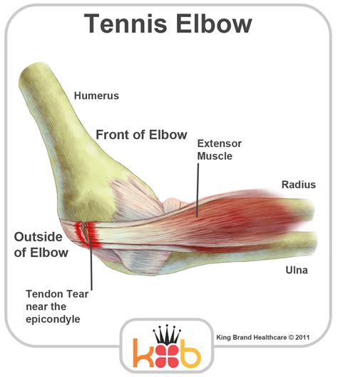 It lies at the origins and insertion of skeletal muscle fibers into the tendons of skeletal muscle. King Brand Elbow Images