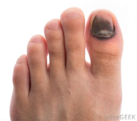 Use them in commercial designs under lifetime, perpetual & worldwide rights. What Is a Toenail Melanoma? (with pictures)