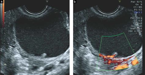 Ovarian Cancer Ultrasound Of Ovaries With Cyst Sonographic Assessment