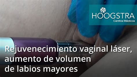 Rejuvenecimiento Vaginal Láser Aumento De Volumen De Labios Mayores 16096 Youtube