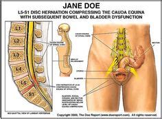 Symptoms vary depending on which nerve root is these are typical pain patterns associated with a cervical disc herniation, but. L4, L5, S1 - Google 搜尋 | Musculoskeletal Illustration | Pinterest | Sciatica, Physical therapy ...